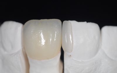 Additional veneer: una soluzione minimamente invasiva