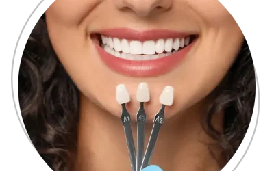 Faccette Dentali Minimamente Invasive: Il Segreto di un Sorriso Naturale e Senza imperfezioni