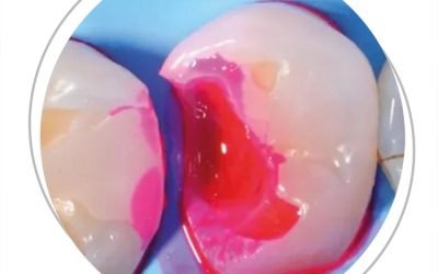 L’Innovazione dello Studio Gellini: Il Liquido Rilevatore di Carie per una Diagnosi Avanzata