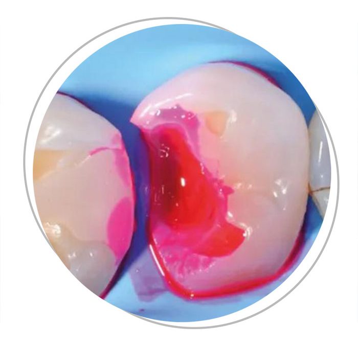 L’Innovazione dello Studio Gellini: Il Liquido Rilevatore di Carie per una Diagnosi Avanzata