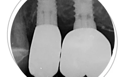 Impianti dentali: il rigetto non esiste