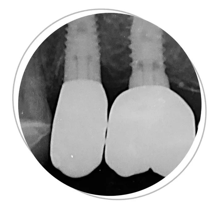 Impianti dentali: il rigetto non esiste