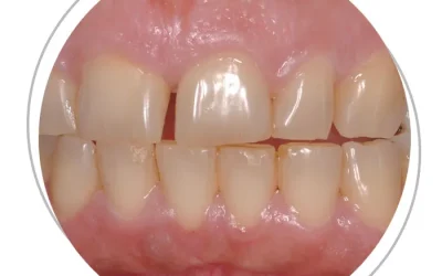 Se i denti anteriori sono troppo corti non è solo un problema estetico