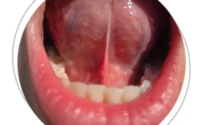 Deglutizione atipica, frenulo linguale corto e postura: una connessione spesso sottovalutata