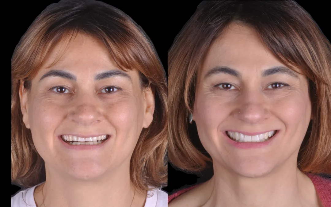 Faccette Dentali a Roma: Guida Completa per Scegliere con Consapevolezza