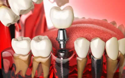 Impianti Dentali Senza Bisturi a Roma: la Chirurgia Flaples
