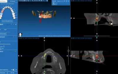 Impianti dentali 3D: perché oggi il trattamento si progetta prima di iniziare